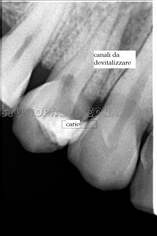 radiografia di dente da devitalizzare caso 1