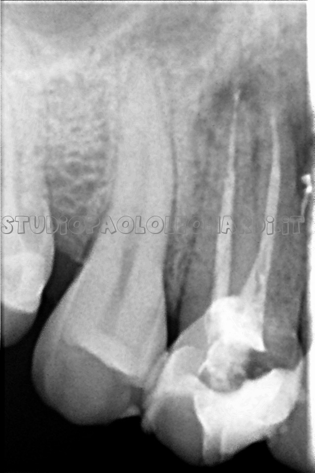 radiografia di dente devitalizzato caso 1