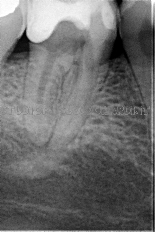 radiografia di dente da devitalizzare caso 2