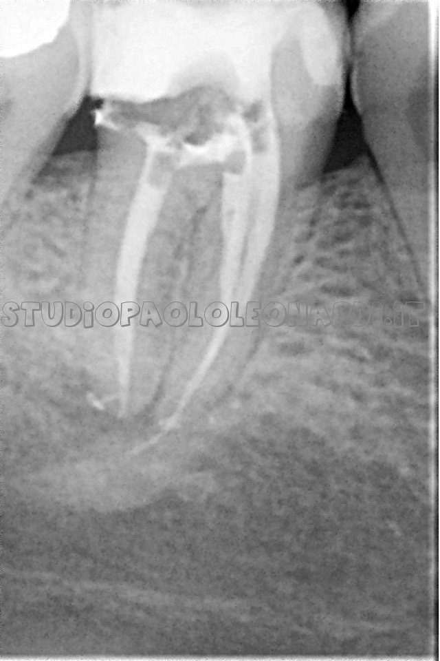 radiografia di dente devitalizzato caso 2