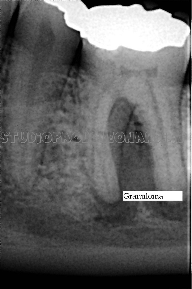 radiografia di dente da devitalizzare caso 3