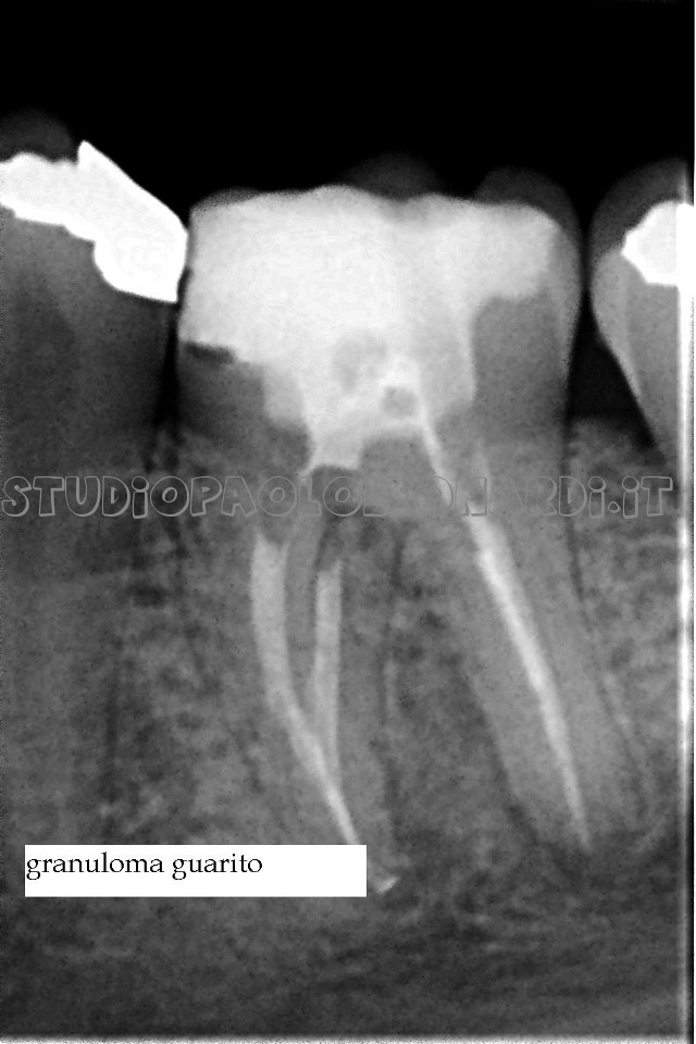 radiografia di dente devitalizzato caso 3