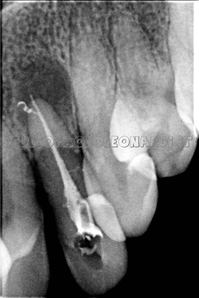 grosso granuloma appena devitalizzato