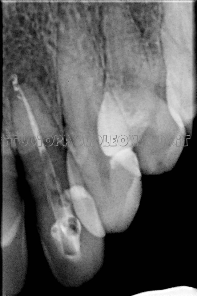 grosso granuloma 12 mesi post devitalizzazione