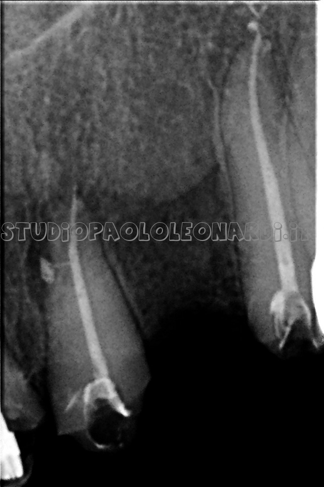 esempio radiografico devitalizzazione