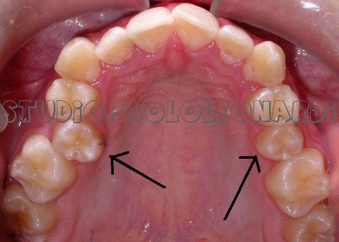 estrazione denti per allineamento