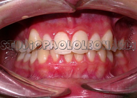 estrazione denti per allineamento altra vista