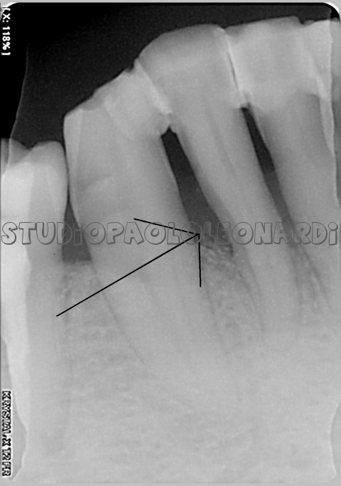 radiografia perdita osso step 2