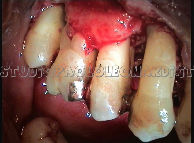 parodontite 2° caso altra vista
